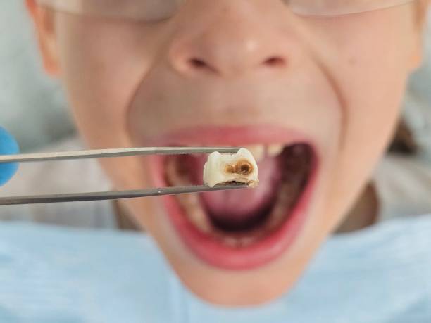 Best Emergency Tooth Extraction in Sterling Heights, MI